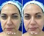 How to choose the Best Botox Treatment in Delhi