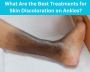 What Are the Best Treatments for Skin Discoloration on Ankle