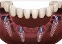 All On Four Dental Implants Las Vegas