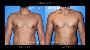 Redefine Your Confidence with Gynecomastia Surgery