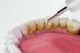Dental Crowns: A Reliable Solution for Damaged Teeth