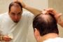 Balding and Hair Loss - Life Extension