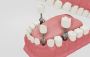 Dr. Manish Shah dental Implants in Ahmadabad | 9825158578