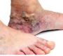 Understanding the Causes of Purple Skin on Legs