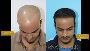 Best Hair Transplant in India |Clinique Internationale