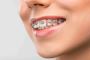 Perfect Smiles: Leading Invisalign in The Colony, TX