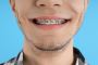 Get the Best Fast Clear Braces in Eugene, Oregon