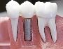 Dental Implant in Los Angles | Dentist of Woodland Hills