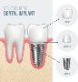 Dental Implants in Los Angeles for Missing Teeth 