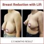 Breast Reduction Surgery in India | World's Best Plastic Sur