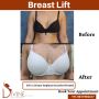 BREAST AUGMENTATION WITH IMPLANT AND LIFT IN INDIA