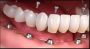 Same day crown Las Vegas by Functional Aesthetic Dentistry