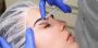 Botox Cosmetic Injection Treatment in Richmond Hill