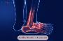 Achilles Tendinitis Treatment in India Achilles Tendinitis Treatment in India