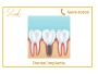 Dental implants in Coimbatore | Tooth implant | fix tooth