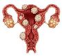 Fibroid Surgery cost in India
