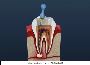 Root Canal Treatment In Delhi