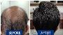 Transform Your Look with Expert Hair Transplant Services in 