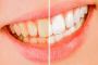  Things to Consider Before Undergoing Teeth Whitening in Sou