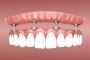 Different Types of Dental Implants You Can Undergo in Southe