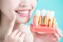 HOW TO CARE FOR YOUR DENTAL IMPLANTS?