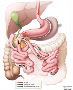 Duodenal Switch