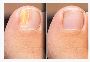 How To Clear Nail Fungus 3X Faster Even While Sleeping