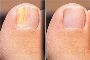 How To Clear Nail Fungus 3X Faster Even While Sleeping
