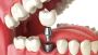 Revolutionize Your Smile With All On 4 Dental Implants In Ti
