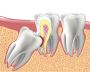 Root Canal in Oakville
