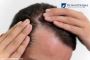 Alopecia Treatment | Hair Loss, Excessive Hair Fall due to D