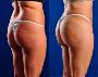 Before and After Pictures of Brazilian Butt Lift
