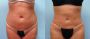 Liposuction Services In Houston