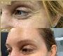 Botox in Dubai: Enhance Your Beauty at Skin111