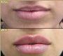 Plump & Define Your Lips with Lip Fillers in Dubai | Skin111