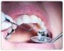 Affordable & Best Dental Implants in Brampton | Smilematters