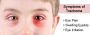 Trachoma - Symptoms, Causes, and Treatment | Specialty Care 