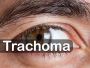 What are Causes & Risks Factors of Trachoma?