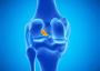 Affordable ACL Ligament Surgery In Dubai