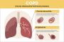 Dr. Virendra Singh - A Leading COPD Specialist in Jaipur