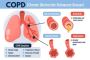 Comprehensive Care for COPD: Meet Dr. Virendra Singh, Your C