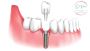 Cost of all on 6 dental implants