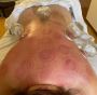 Ease Back Pain Naturally: Cupping Therapy at Acupuncture Sco