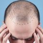 Hair loss treatment in Pune