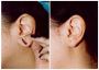Ear lobe repair Treatment in Pune