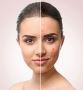  Skin Pigmentation Treatment in Pune