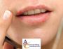 Your hives on lips need best treatments 