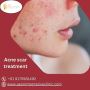 Skin Renewal Unleashed: Specialized Acne Scar Therapy