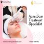 Say Goodbye to Acne Scars with Our Expert Team in Pune!