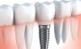 Painless Dental Implans in India